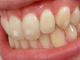 Изменение цвета эмали зуба